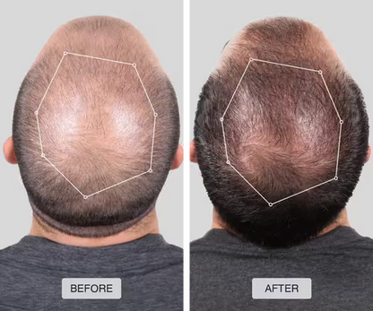 CrownRevive™ Hair Growth Cap - Revive Thinning Hair with Laser Therapy