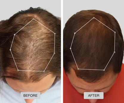 CrownRevive™ Hair Growth Cap - Revive Thinning Hair with Laser Therapy
